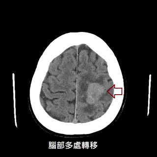 腦部斷層2