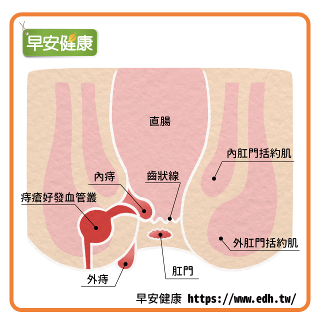痔瘡可分為內痔、外痔，依據發生位置是否在肛門齒狀線以內而有不同。