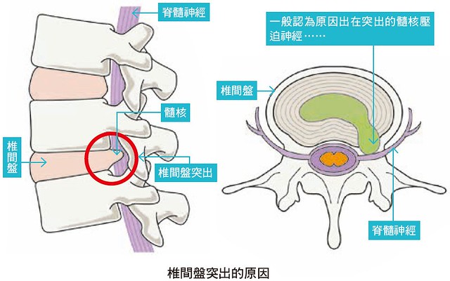 椎間盤突出的原因