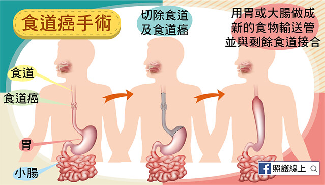 食道癌手術