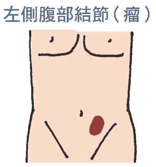 左側腹部結節（瘤）