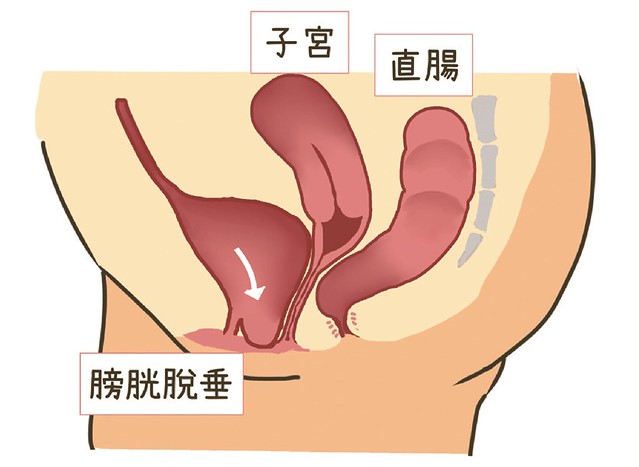 陰道前壁（膀胱）脫垂