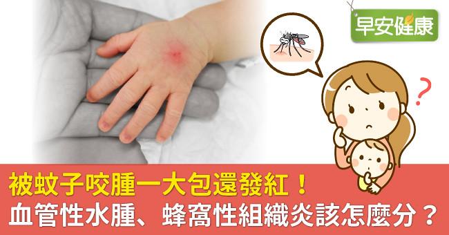 被蚊子咬腫一大包還發紅！血管性水腫、蜂窩性組織炎該怎麼分？