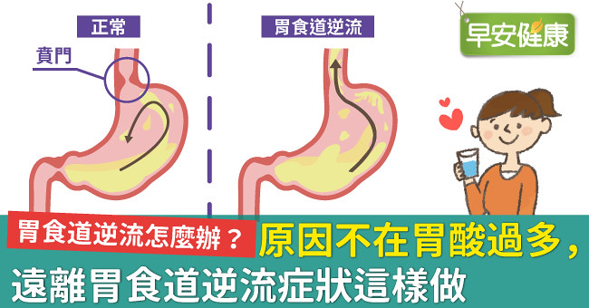 胃食道逆流怎麼辦？原因不在胃酸過多，遠離胃食道逆流症狀這樣做