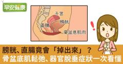 膀胱、直腸竟會「掉出來」？骨盆底肌鬆弛、器官脫垂症狀一次看懂