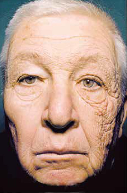 左臉長期照射陽光，老化程度更嚴重