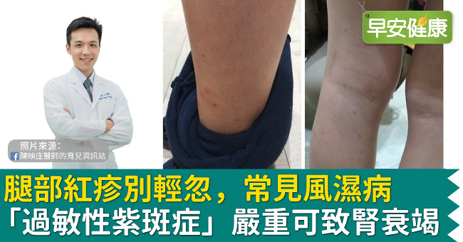 腿部紅疹別輕忽，常見風濕病「過敏性紫斑症」嚴重可致腎衰竭