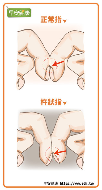 杵狀指檢測：兩隻食指間的縫隙