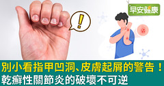 別小看指甲凹洞、皮膚起屑的警告！乾癬性關節炎的破壞不可逆