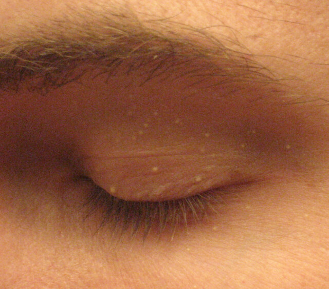 成年男性眼周的粟粒腫