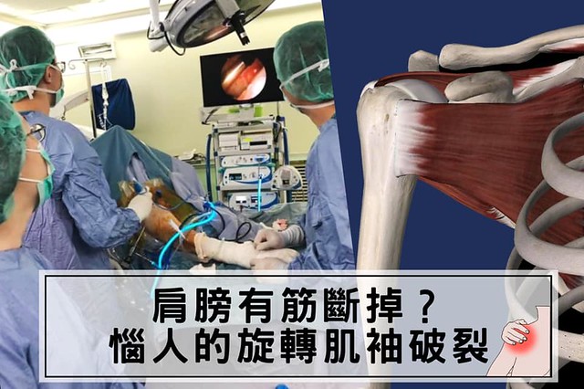 肩膀有筋斷掉？惱人的旋轉肌袖破裂