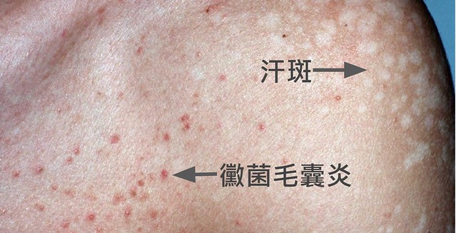 汗斑與黴菌毛囊炎的差異。
