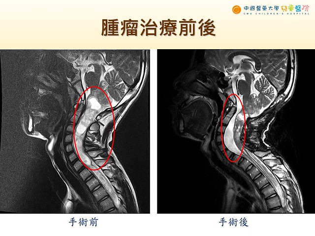 兒童腫瘤治療前後
