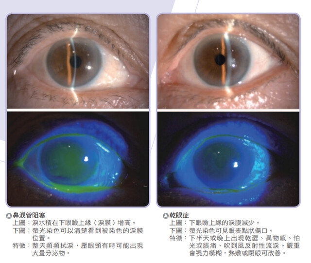 鼻淚管阻塞 v.s. 乾眼症