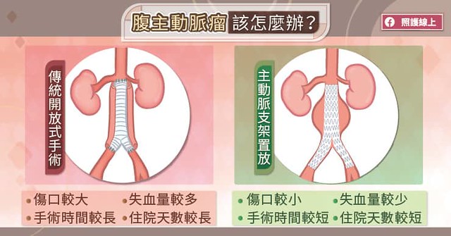 腹主動脈瘤該怎麼辦？