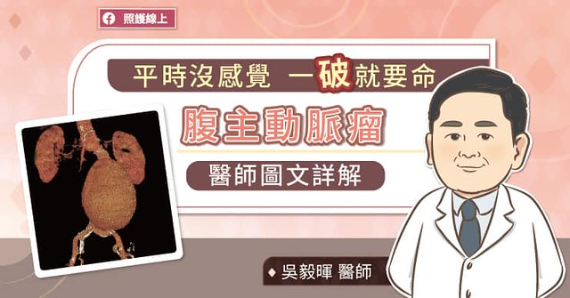平時沒感覺、一破舊要命的腹主動脈瘤
