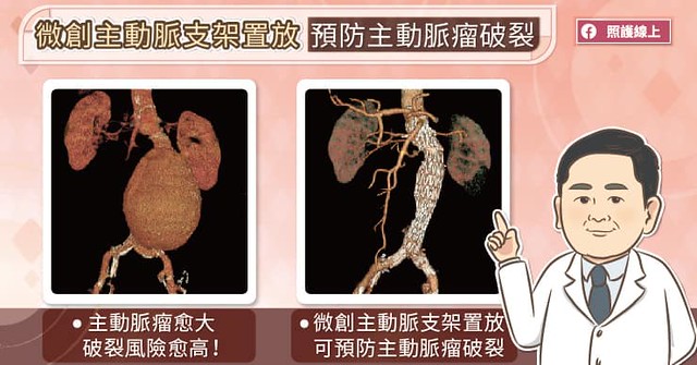 微創主動脈支架置放,預防主動脈瘤破裂。
