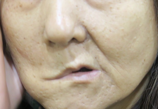 腮腺腫瘤如果大到壓迫或侵犯顏面神經,便會造成顏面失調