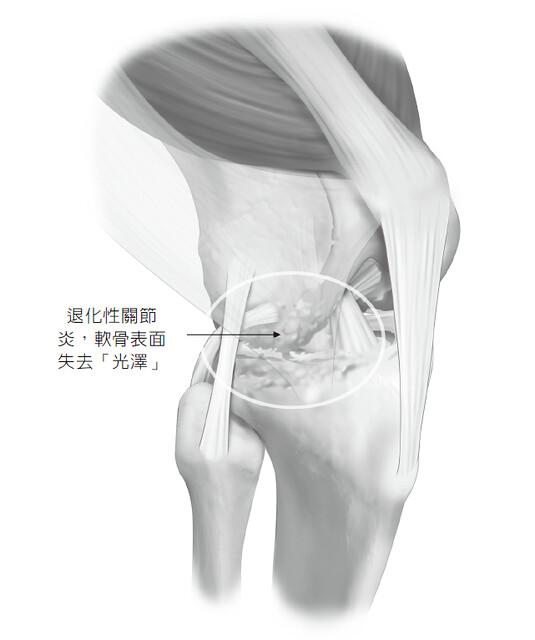 關節炎