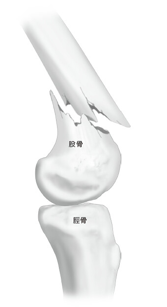 股骨遠端骨折
