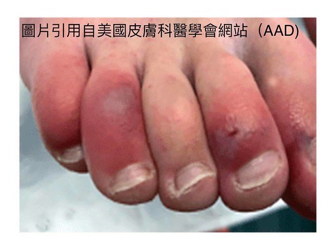新冠腳趾（COVID toe)又紅又紫、略微水腫的腳趾，局部有水泡。