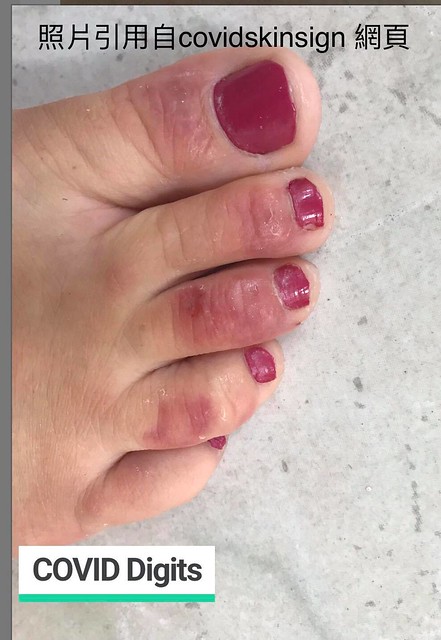 新冠腳趾（COVID toe）又紅又紫、略微水腫的腳趾，局部有水泡。