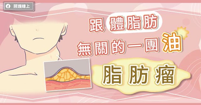 跟體脂肪無關的一團油-脂肪瘤