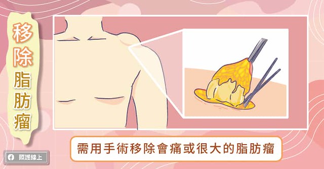 移除脂肪瘤