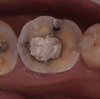 因大範圍銀汞合金填補造成的牙齒的小裂紋