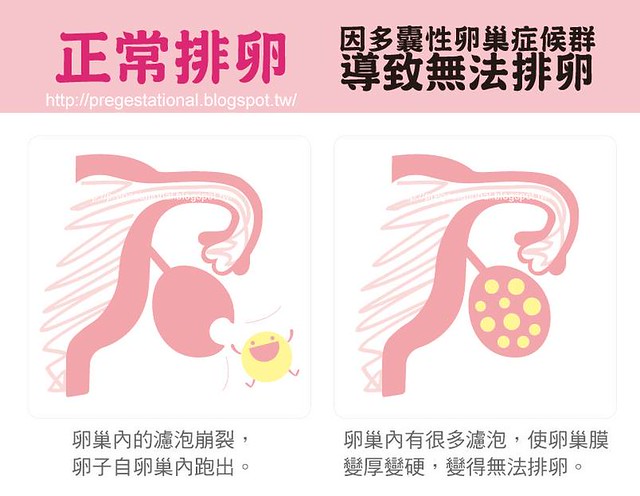 多囊性卵巢症候群造成患者無法正常排卵。