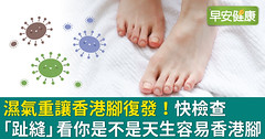 濕氣重讓香港腳復發！快檢查「趾縫」看你是不是天生容易香港腳