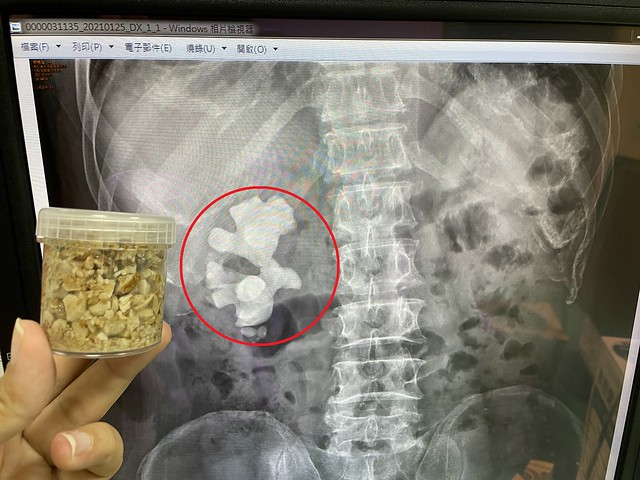 楊先生的左側腎臟出現鹿角狀（珊瑚狀）結石竟有長達8公分，打碎夾出來的結石塞滿盒子，比一顆雞蛋還大。