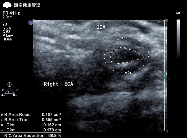 圖一：頸動脈超音波檢查，右頸動脈69.9_阻塞