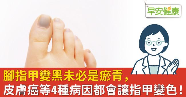 腳指甲變黑未必是瘀青，皮膚癌等4種病因都會讓指甲變色！