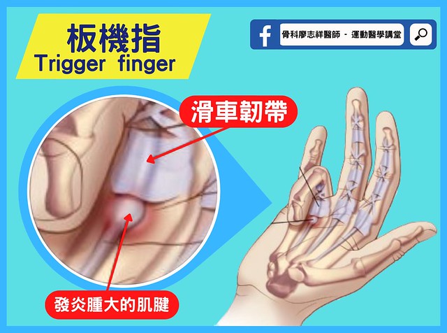 板機指（Trigger finger）正式名稱是「#手指屈指肌腱狹窄性肌腱鞘炎」，最常發生在大拇指、中指、無名指。