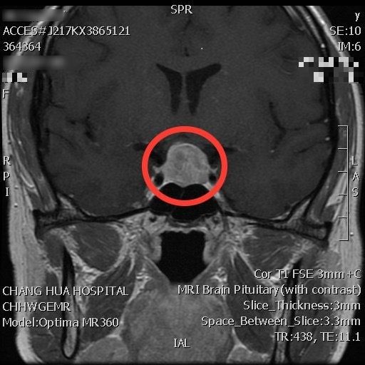 患者頭部核磁共振圖像，紅圈處為腦下垂體腫瘤。