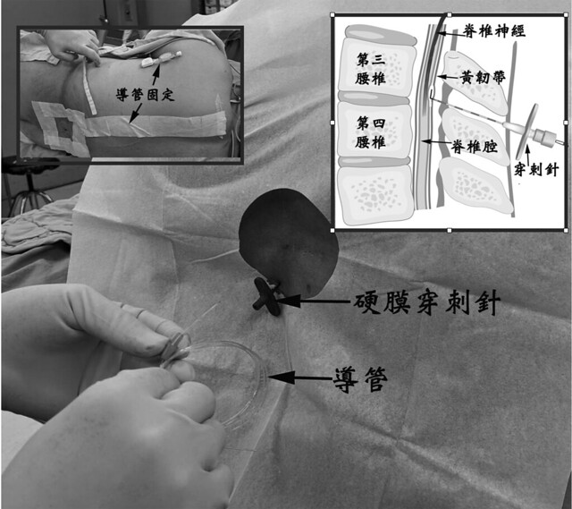 硬膜外（epidural）麻醉注射針頭的位置，導管放置及固定示意圖