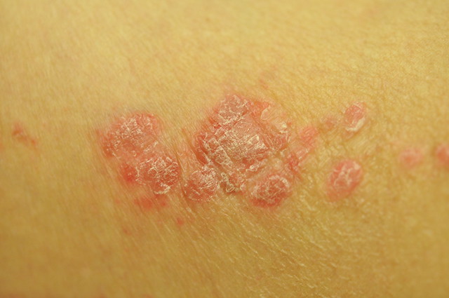 典型的乾癬會呈現邊界清楚的紅斑附著銀白色脫屑。