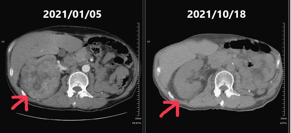 影像報告右邊紅圈處為患者左側肩胛骨直徑約10公分的巨大腫瘤