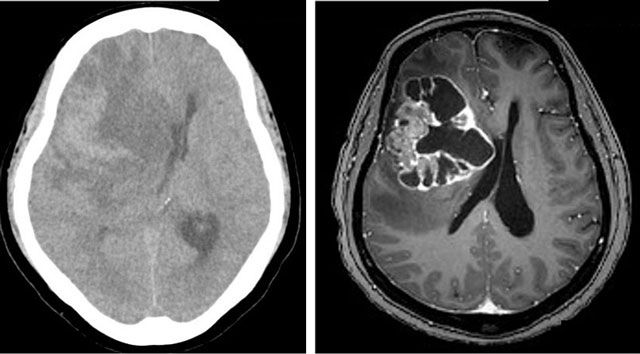 頭部電腦斷層 ( 左 ) 及磁振造影 ( 右 )顯示右側大腦的額葉部 6 公分腫瘤