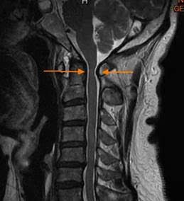 病人術前頸椎核磁共振影像顯示第一頸椎處脊髓受壓迫（詳箭頭處）