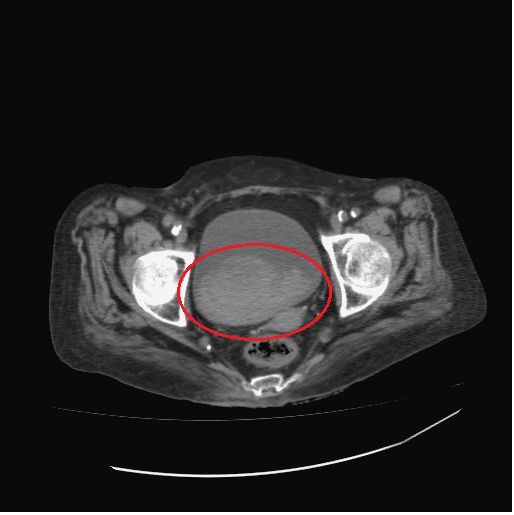 電腦斷層顯示病人膀胱有大量血塊（紅框處）