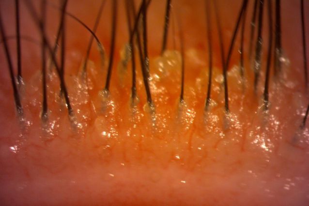 蟎蟲患者的睫毛根部有許多黏稠的的白屑屑。
