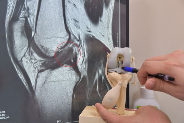 十字韌帶能維持膝關節前後及旋轉的穩定性，如果斷裂就會造成膝關節、軟骨及半月板的損傷，提升日後罹患創傷性關節炎的風險