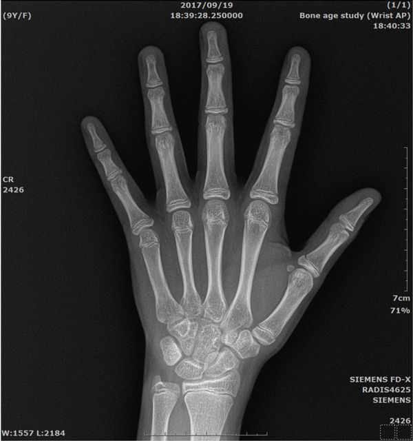 標準之評估骨齡用左手手掌X光片涵蓋範圍