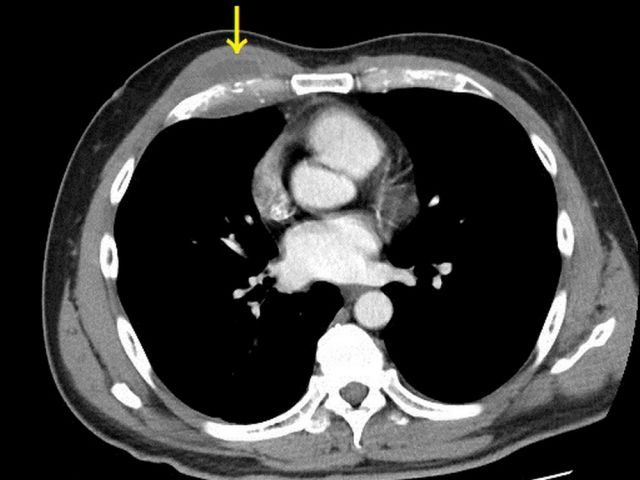 電腦斷層發現胸腔膿瘍，所幸膿瘍範圍雖大，但尚未侵蝕肋膜。