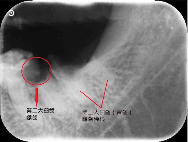 患者因左下側齲齒殘根併發蜂窩性組織炎感染 (1)