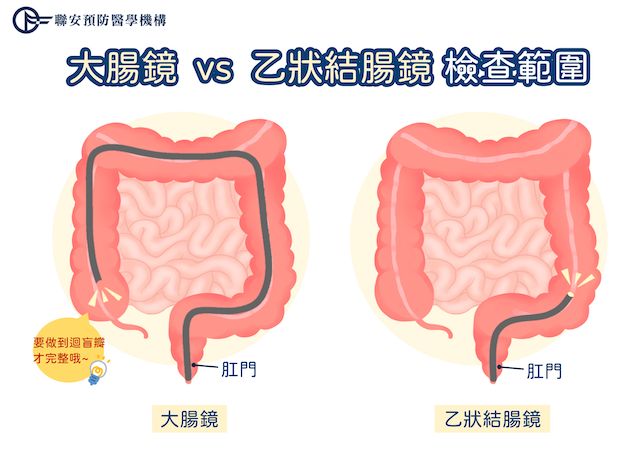 大腸鏡和乙狀結腸鏡差別