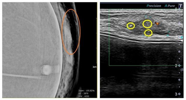 乳房攝影、乳房超音波發現乳房鈣化點，是乳癌特徵