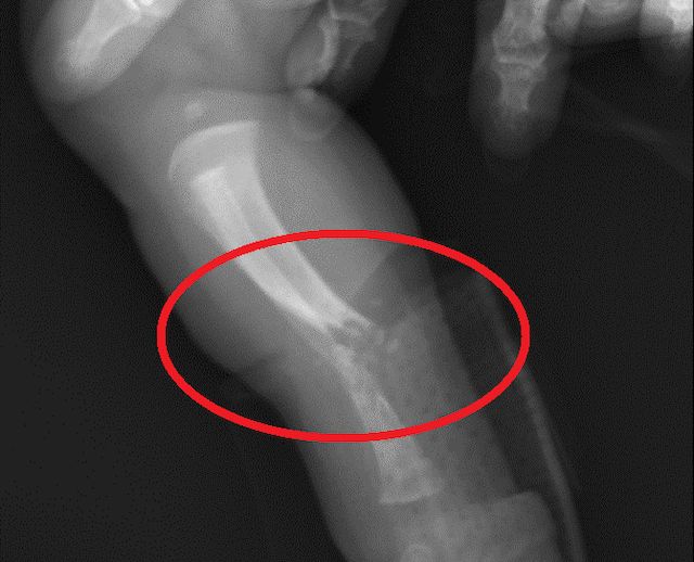 X光顯示女嬰右小腿骨折